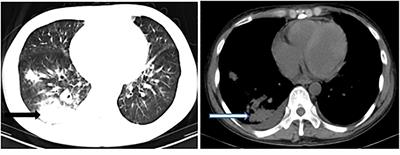 Frontiers Case Report Francisella Philomiragia Bacteremia In A